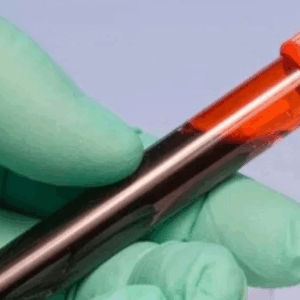 Factor Reumatoide