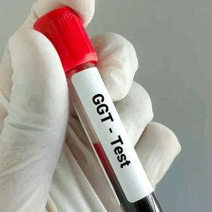 GGT (Gamma Glutamil Transferasa)