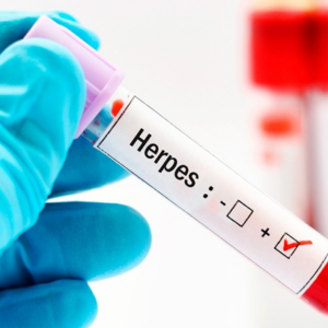 Anticuerpos Anti Herpes 1 IgG/IgM