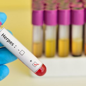 Anticuerpos Anti Herpes 1 IgM