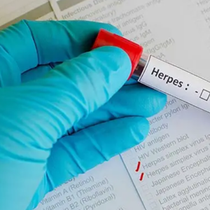 Anticuerpos Anti Herpes 2 IgG/IgM