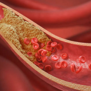 Colesterol LDL