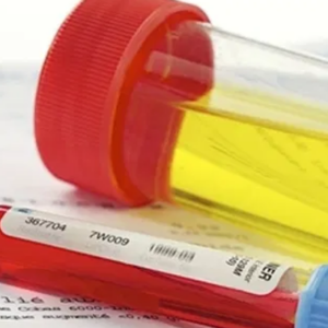 Proteínas en Orina de 24 horas (Proteinuria 24 hrs)